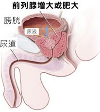 前列腺肥大可以治好嗎