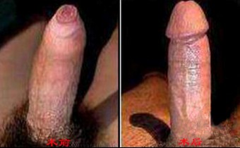 包皮過長和包莖的區別