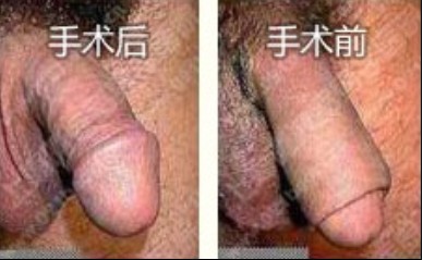 包皮過長必須做手術嗎