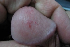 龜頭包皮炎的癥狀表現有哪些