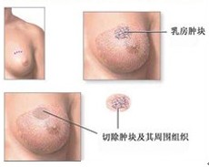導致乳腺增生的原因是什么