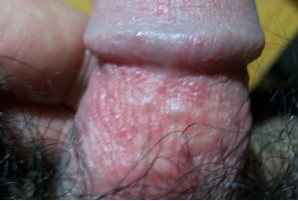 如何治療包皮龜頭炎