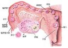 卵巢性不孕是怎么引起的